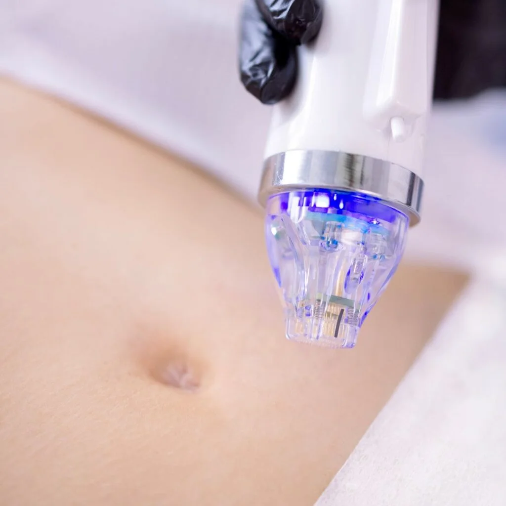 Radiofrequenz und Microneedling