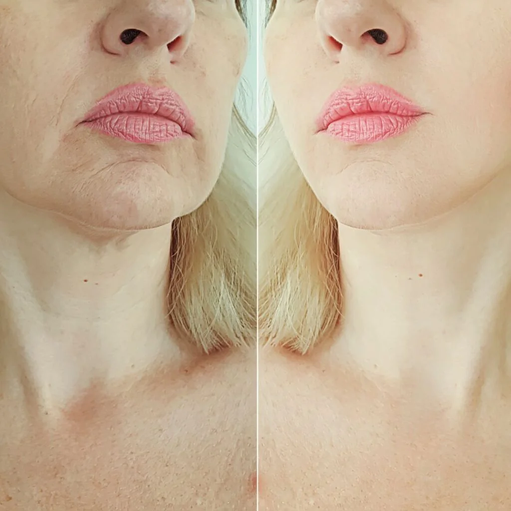 Chin-tox: Botox zur Kinnkontur