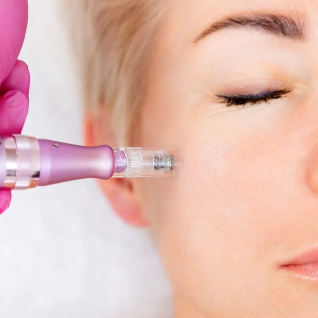 Nahaufnahme einer Frau, die eine Microneedling-Behandlung erhält