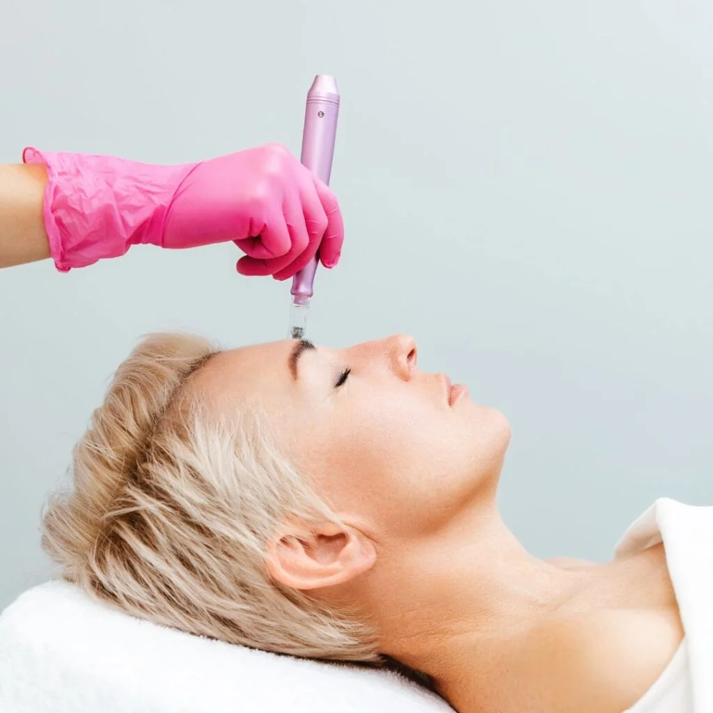 Eine Frau erhält eine Microneedling-Behandlung zur Anti-Falten-Pflege und Verbesserung der Hautstruktur