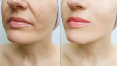 Chin-tox: Botox zur Kinnkontur